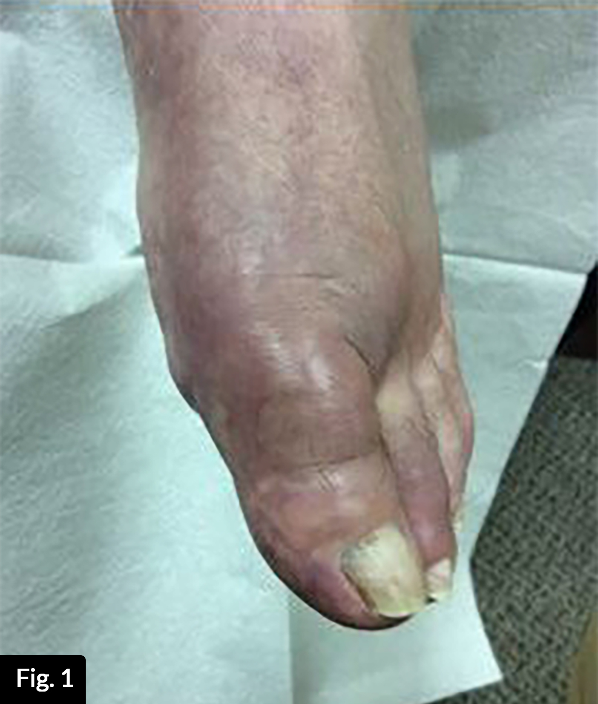A Case of Severe Pain and Swelling in the Foot